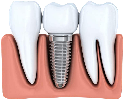 Переваги нового зуба, замість втраченого:  Переваги нового зуба, замість втраченого: