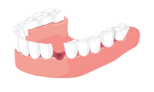 Зуб втрачений Зуб втрачений