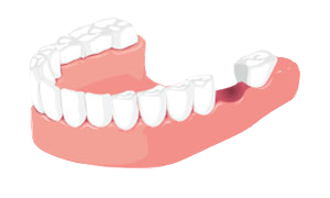 Видалений зуб Видалений зуб