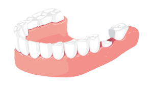 Зруйнований зуб Зруйнований зуб