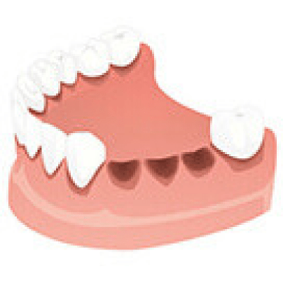 Пародонтит Пародонтит