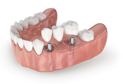 Що таке коронка на імпланті під ключ?