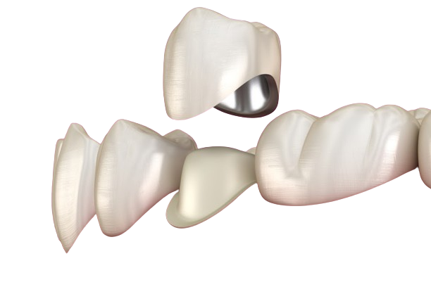 Переваги вибору металокераміки