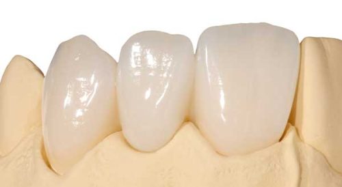 Чому професіонали обирають коронки E-max? Чому професіонали обирають коронки E-max?