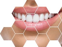 Плюси вибору зубних протезів