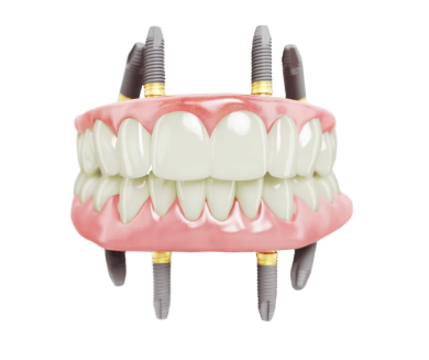 Переваги методики імплантації All-on-4