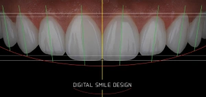 3D-моделювання зубів